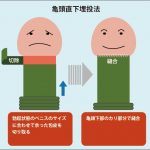 亀頭直下埋没法