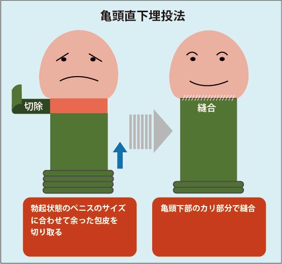 陰茎小帯 Frenulum of prepuce of penis JapaneseClass.jp